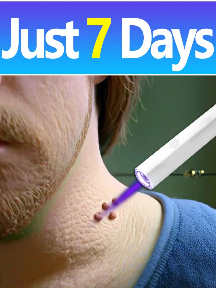 2025, unisex hete verkoop blauwlichtpen, lost wratten op, huidlabelverzorging, draagbaar gereedschap