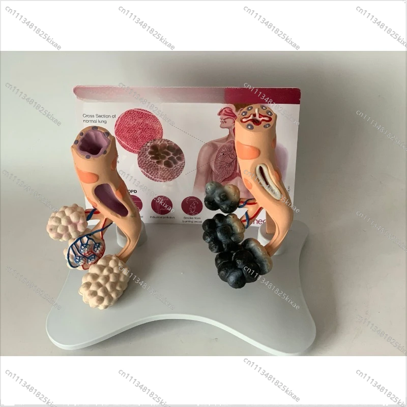 For Smoking Alveoli and Healthy Alveoli Lung Comparison Model Human Lung Respiratory System Teaching Model Mold