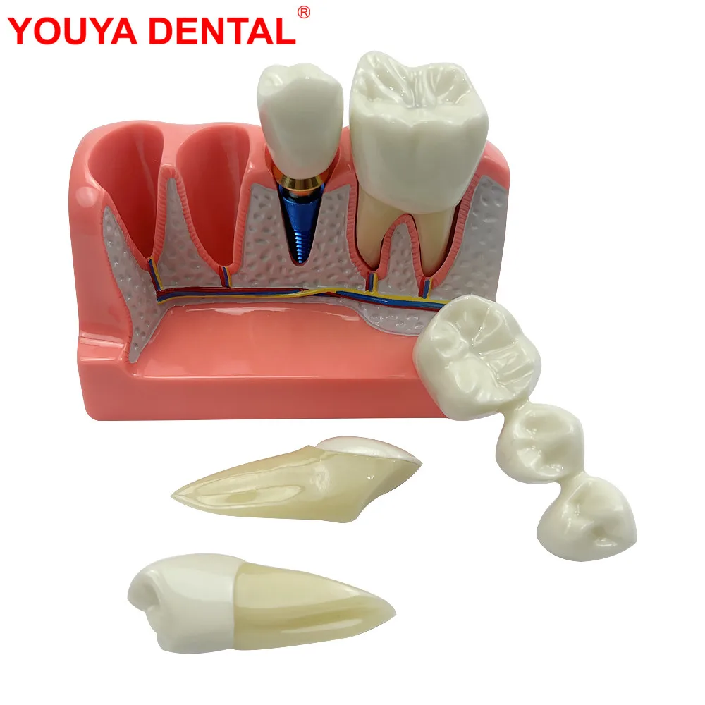 4 Times Dental Teaching Model With Removable Teeth Implant Model Dental Bridges Crown Dentistry Dentist Education Study Model