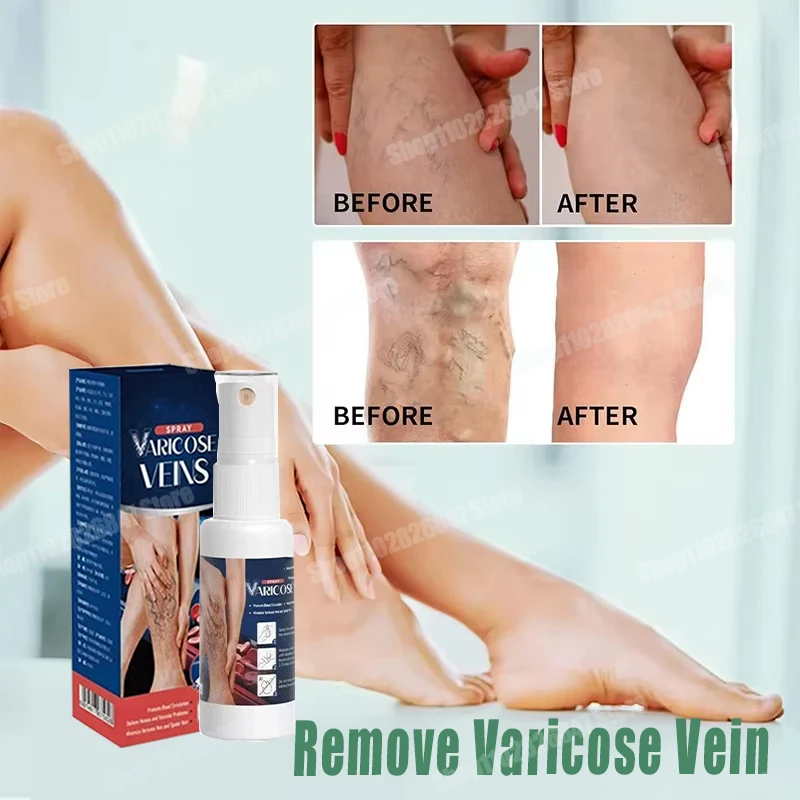 

Rapid Varicose Vein Spray Natural Herb Veins Soothing Essential Oil Spray Vasculitis Phlebitis Spider Vein Earthworm Leg Cure