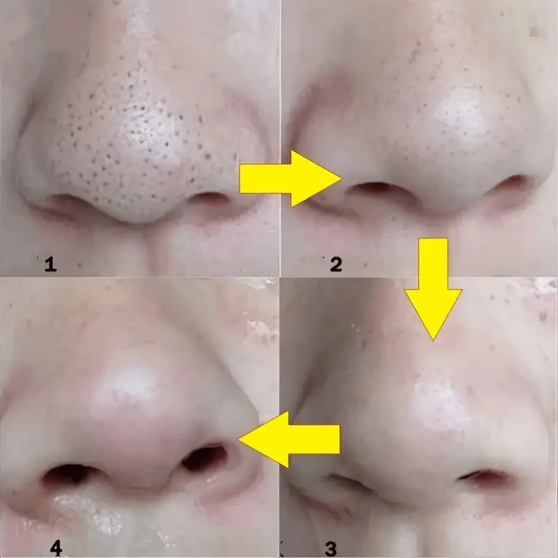 Nez points noirs enlever masque plâtre nez bandes enlever points noirs Pores points noirs dissolvant acné Peel masque Patch de nettoyage soins de la peau