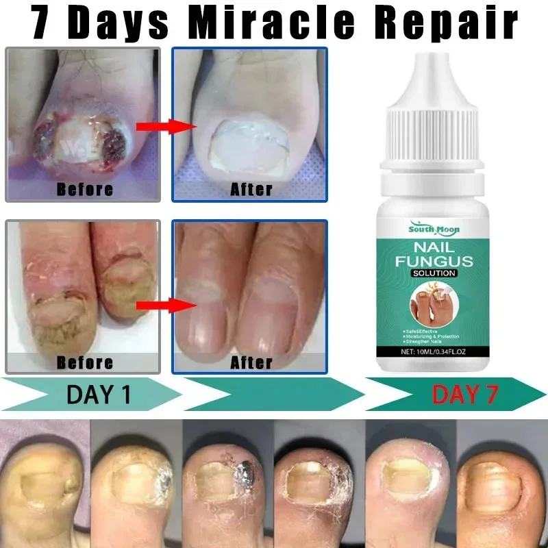 真菌性爪治療エッセンスオイル爪真菌レーザー装置修理足の爪指の爪生姜治療手足エッセンス液体