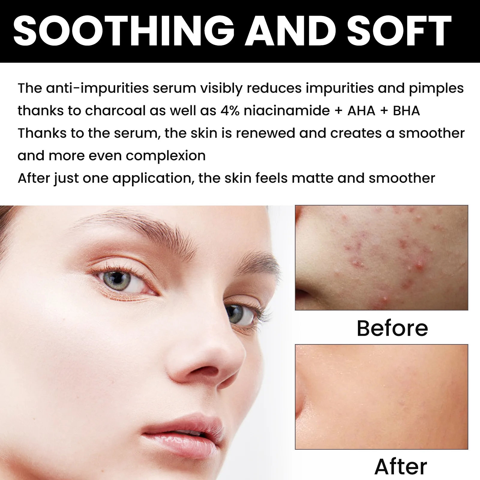 Anti Acne Face Serum Fade Acne Marks Remove Blackheads Pores Shrinking Moisturizing Repair Skin Nicotinamide Brightening Essence