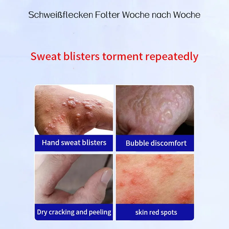 German Sweat Blister Ointment for Blisters, Peeling, Redness, Heat, Itching, Sweat Blisters, Red Spots, Itching, Dryness, and Itch Relief