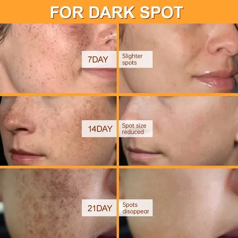 ที่มีประสิทธิภาพไวท์เทนนิ่งกระครีม Dark Spot Corrector ลบฝ้าจางเมลานินสีผิวกระจ่างใส Care ผลิตภัณฑ์