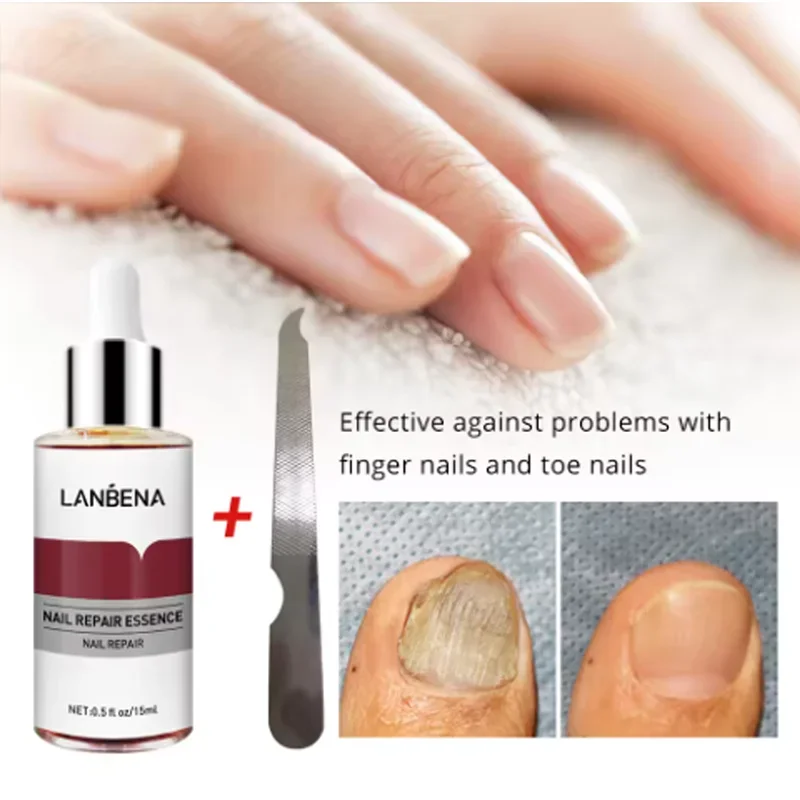 2024 LANBENA Fungus Care Remove Onychomycosis Toes Nourish Brighten Hands Feet Product Repair Suitable Women Nail Pepair Essence