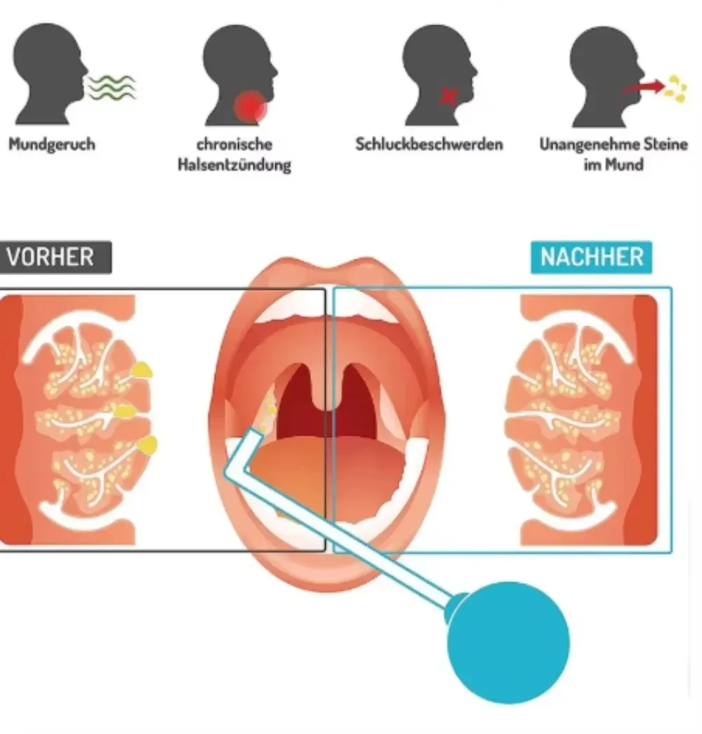 Portable Tonsil Stone Remover Tool Mouth Cleaning Care Tools Ear Wax Tonsil Stone Suction Ball Bad Breath Removal Throat Manual