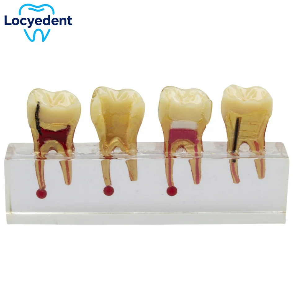 

Dental Teaching Model Transparent Root Canal Practice Model Disease Teeth Model Technician Endodontic Treatment Studying