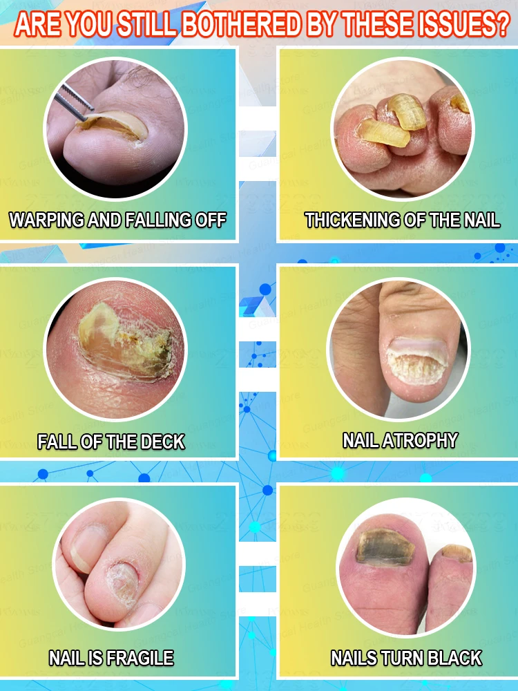 تساعدك على التخلص من فطار الأظافر. حل مشاكلك بالطرق العلمية. #2