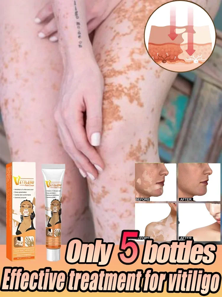 schöne Vitiligo-Salbe, Entfernung von Ringelflechten, Entfernung von weißen Flecken, Hautvitiligo, beseitigt Vitiligo-Creme