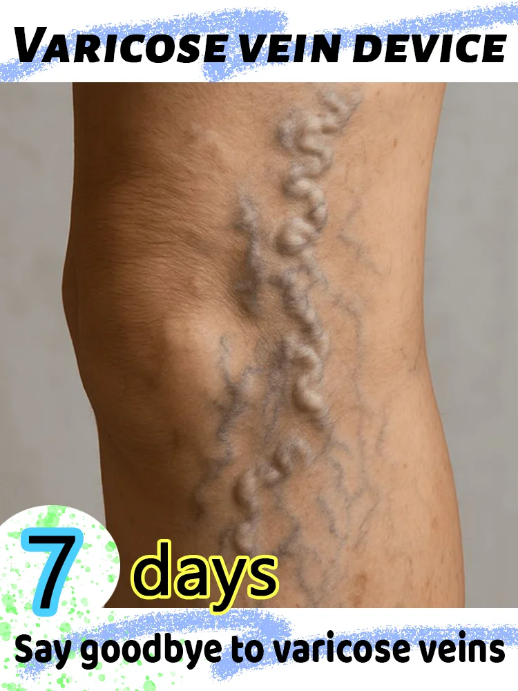 

Say goodbye to varicose veins and enjoy a healthy life