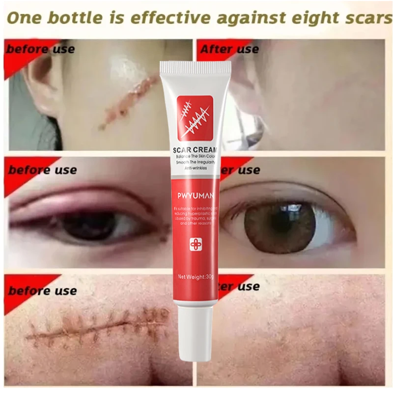 Fast Scar Removal Cream Effective Treatment Stretch Marks Burn Surgical Scars Acne Spot Repair Whiten Moisturize Herbal SkinCare