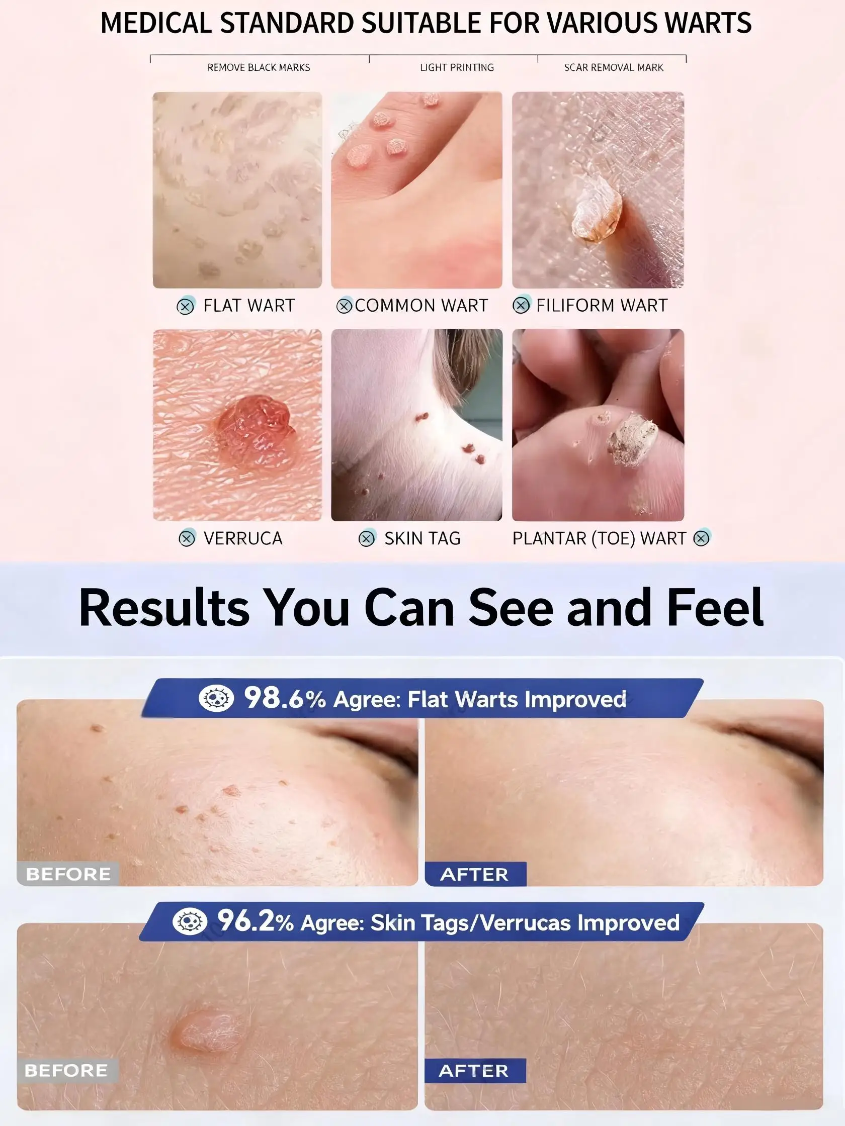 Laser pen point application wart removal