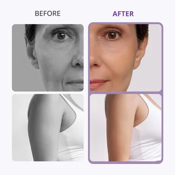 10 best sales Lipo makinesi - №4