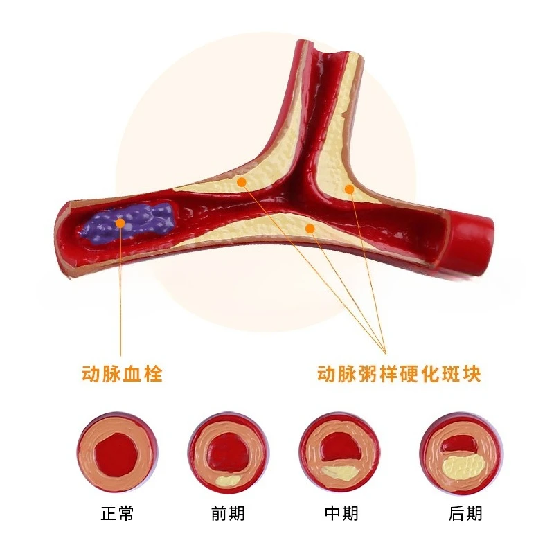 Vascular blockage model, vascular pathological anatomy model