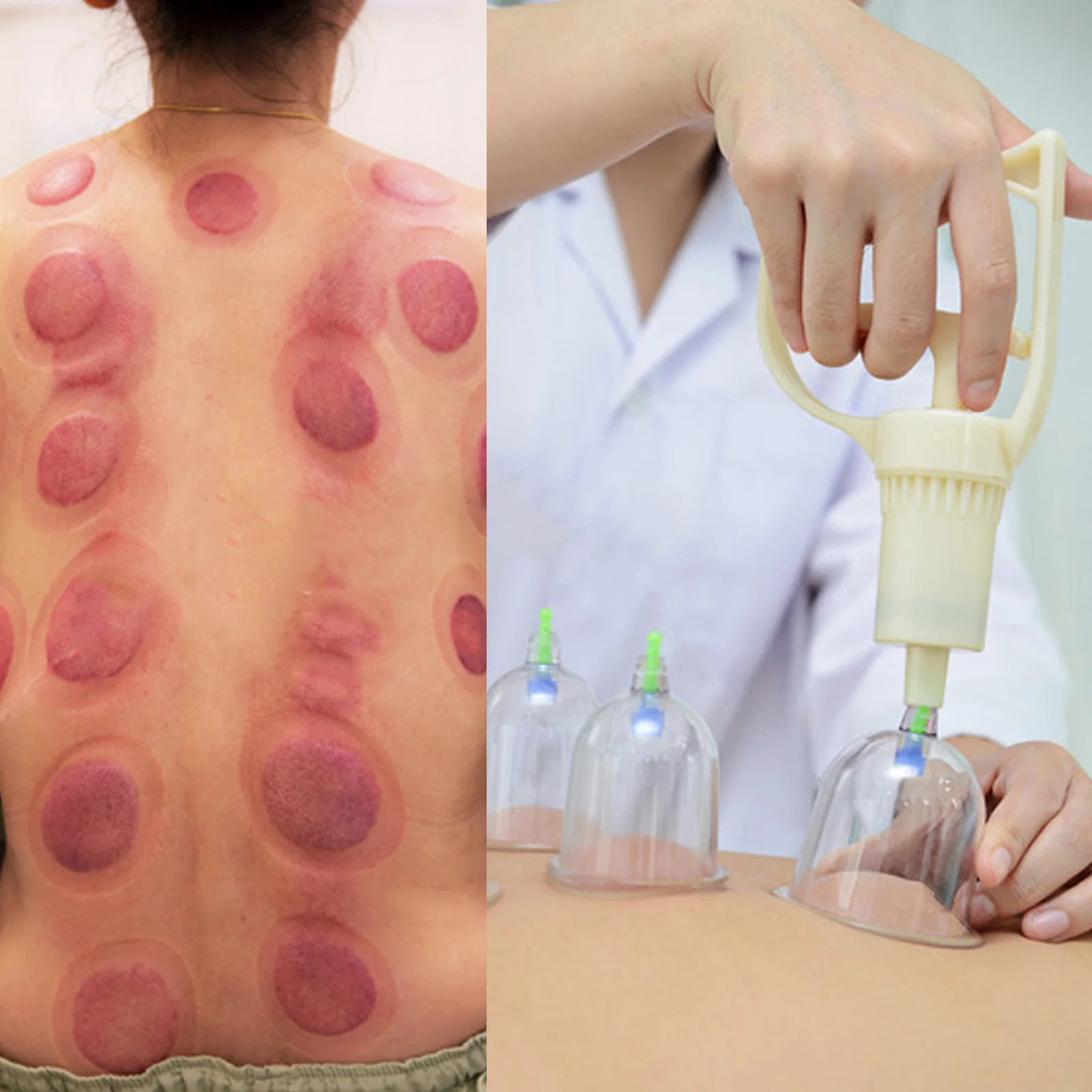 

ZHONGYANTAIHE Cupping Therapy Set Professional 20 Vacuum Suction Cups Face Cupping for Cellulite Remover Relieves Pain Relieving