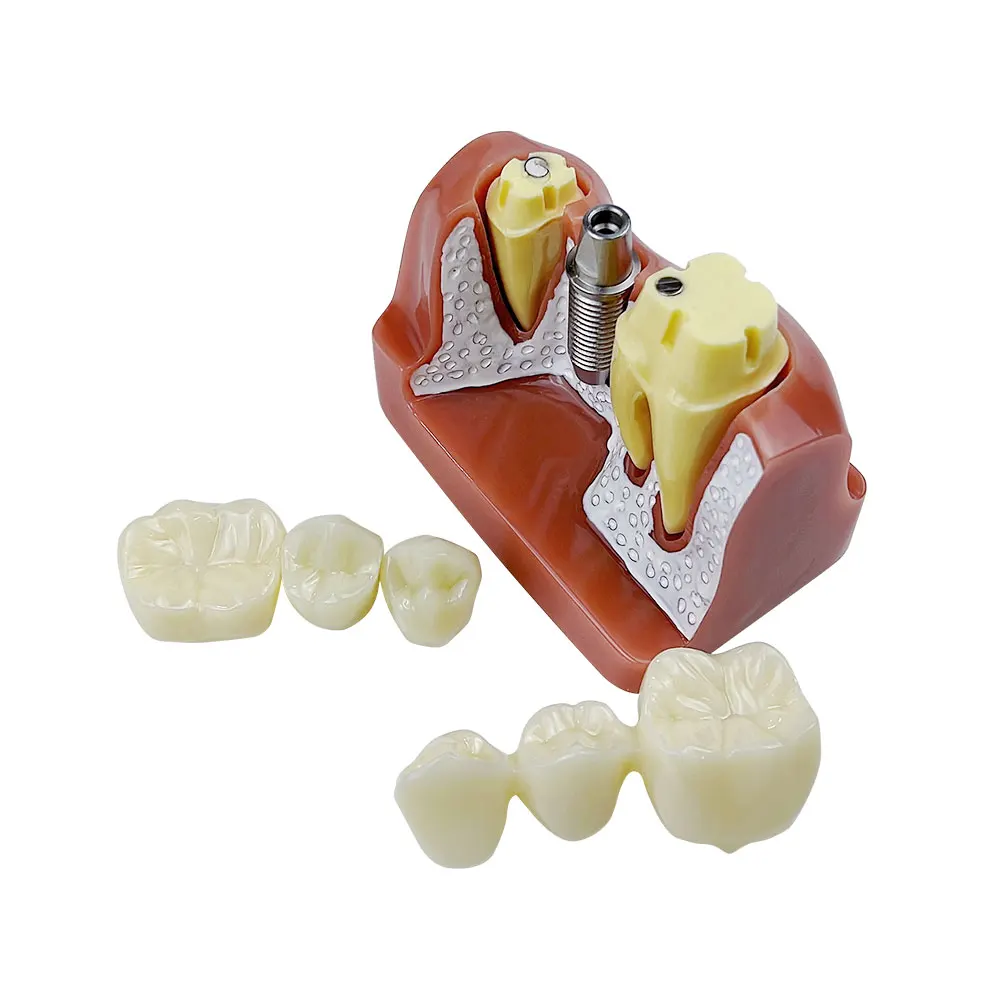 4 Times Implant Teeth Model Denture Bridge Crown Porcelain Restoration Model For Dentist Student Teaching Demonstration Module