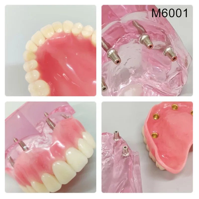 Dental Teaching Model Removable Overdenture NISSIN Kilgore Style Implants Teeth Models for Dentistry Demo Training Tools