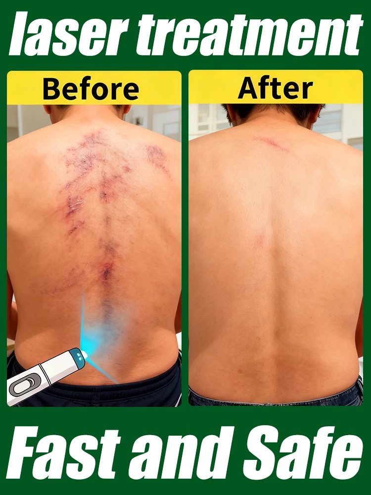 Cicatriz mejorada de tercera generación Reparación de cicatrices raíz uickly