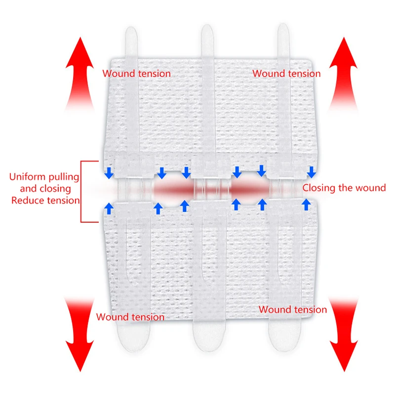 1Pc Rits Band Wond Sluiting Patch Rits Pleister Wond Snelle Hechting Buiten Draagbare Hemostatische Patch EHBO-Tool