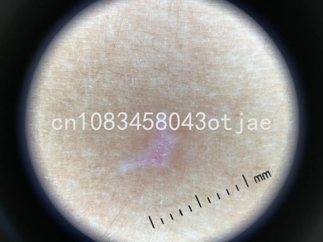 Smartphone Skin Magnifier Dermatoscópio, microscópio médico, dermatoscopia