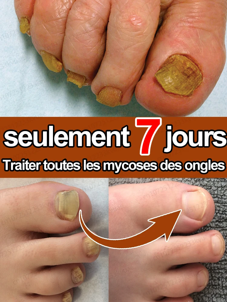 Sérum de traitement contre les mycoses des ongles