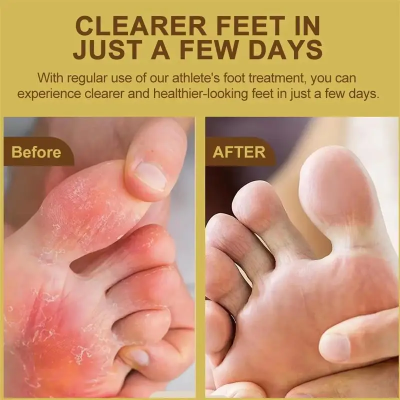 Anti-Foot Fungus Ointment Deodorant Care Products Foot Deodorant Creams Antiseptic and Antiperspirant Foot Skin Topical Cream