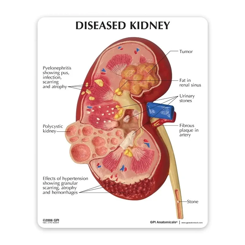

Anatomy Normal and Diseased Kidney Pathologies Medical Science Anatomical Model Human Body Doctors Educational Tool