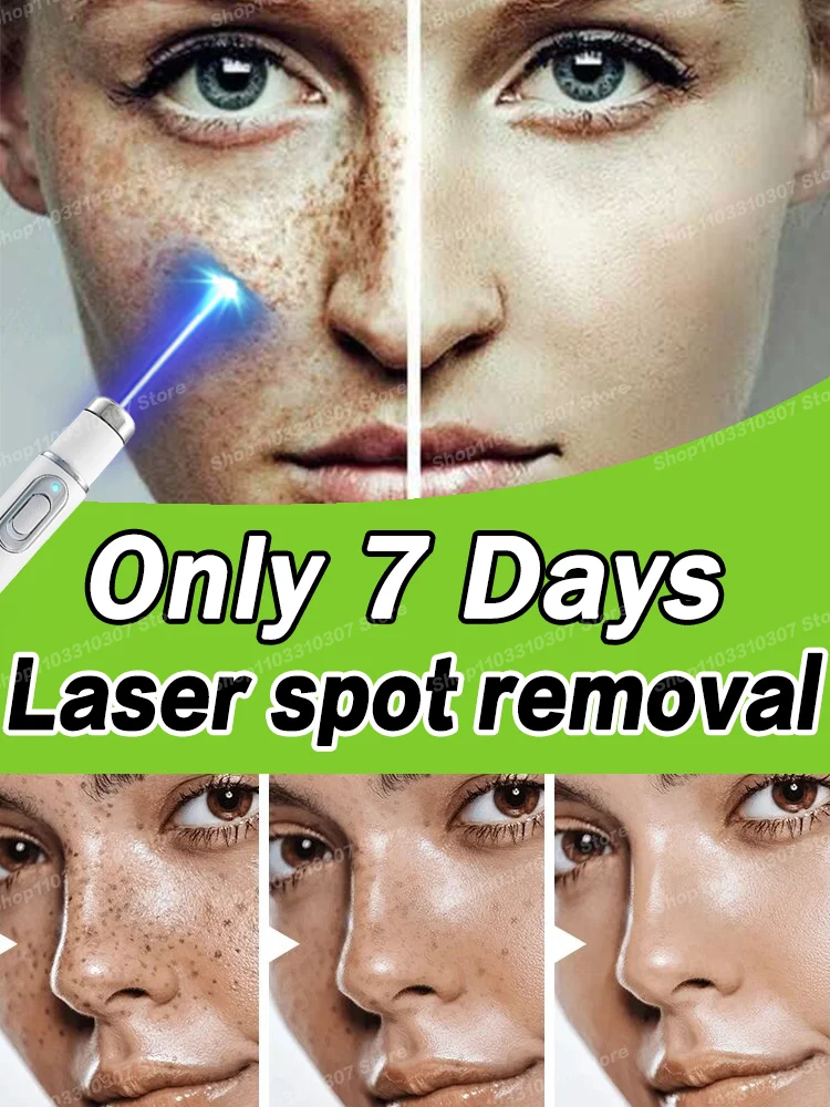 Laser Facial Spots Are Gone