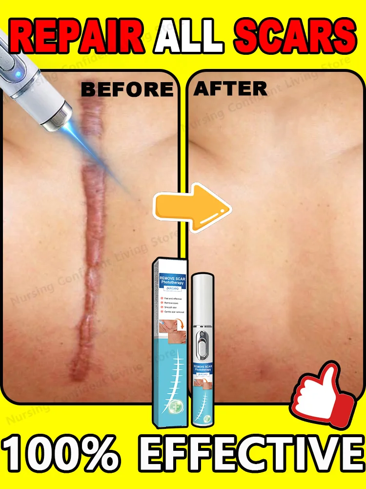 Laser scar repair