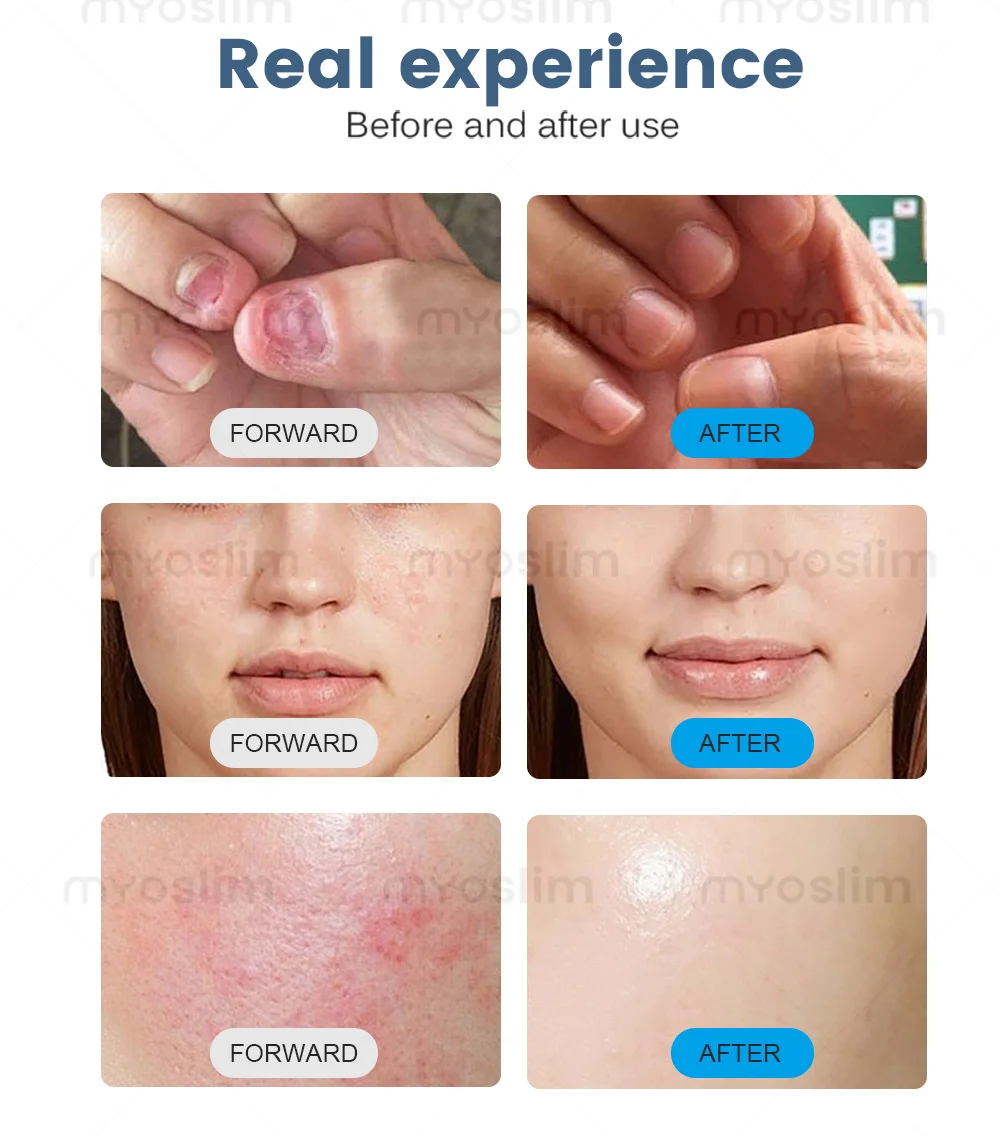 

5 IN 1 Diodo Laser 980 Removal Vascular Machine Spider Vein Eczema Nail Fungus Removal Laser Skin Rejuvenation Machine