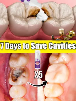 Tooth decay Repair Repairing Cavities Anti Protecting Caries