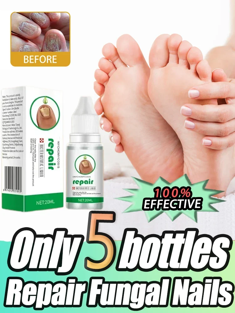 Fungal Nail Treatment Oil Foot Repair Essence Toe Nail Fungus Removal Gel Anti Infection Cream Fungal Nail Removal