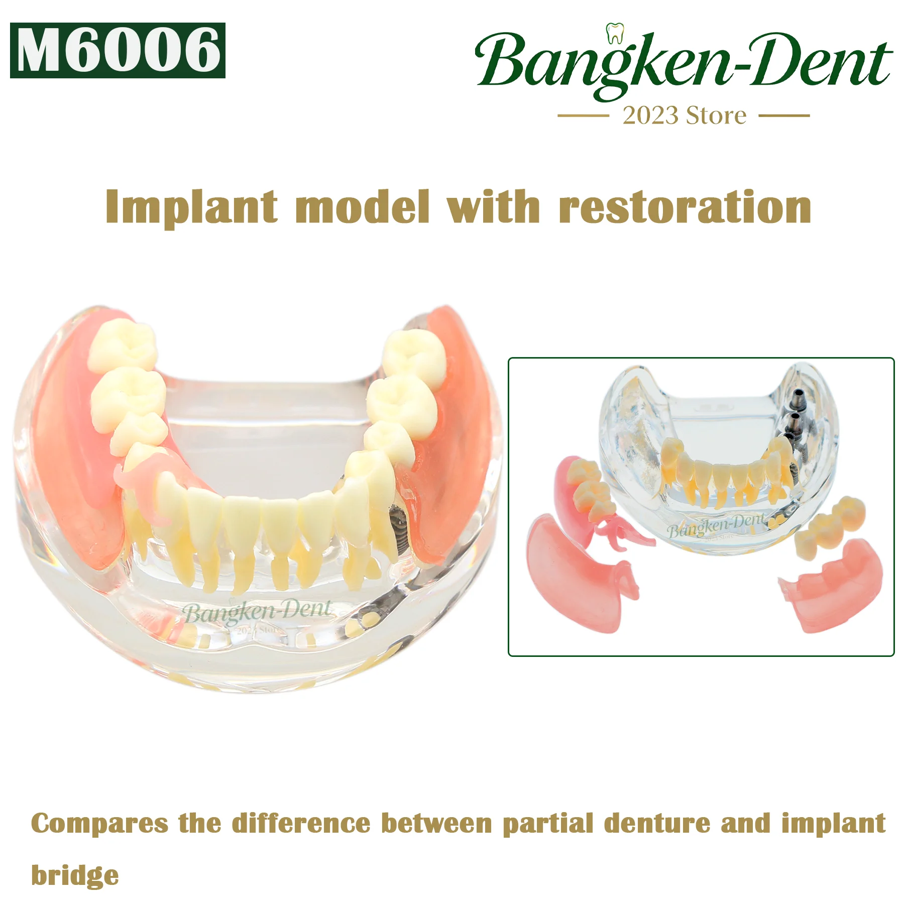 Dental Implant Teeth Model Typodont Overdenture 3 Implants M6006 Inferior Lower Bridge Restoration Treatment Demo Studying Teach