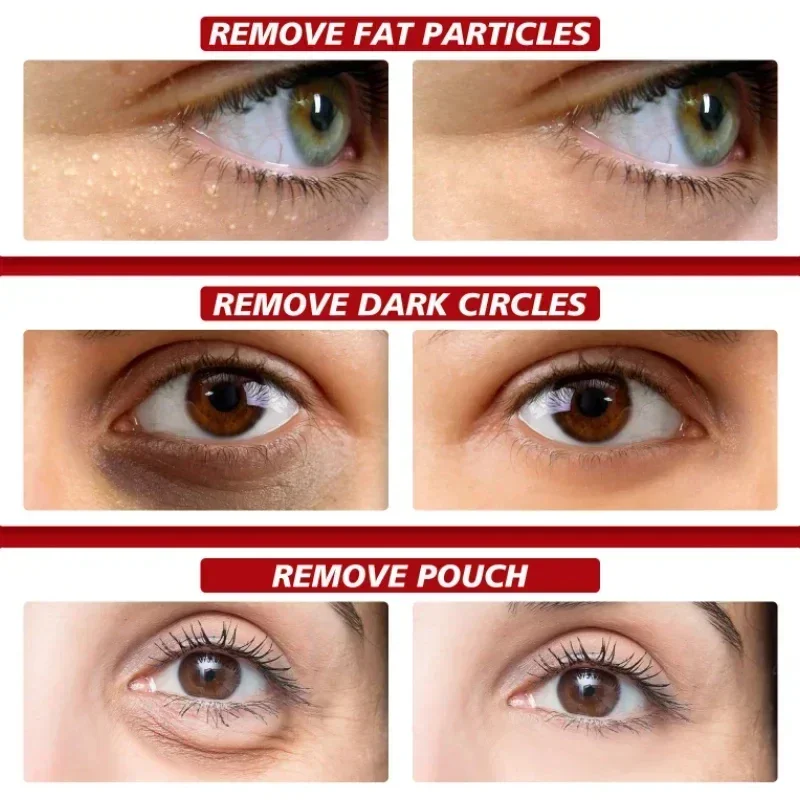 Fat Granules Remover Eye Cream Reduce Dark Circles Fade Fine Lines Repair Barrier Anti-Puffiness Anti Inflammatory Cream