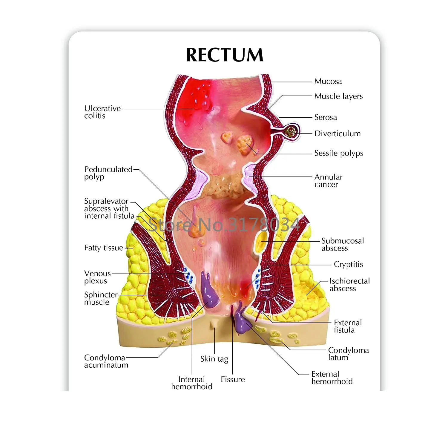 Rectum Model Human Body Anatomy Replica of Rectum w/Common Pathologies for Doctors Office Educational Tool