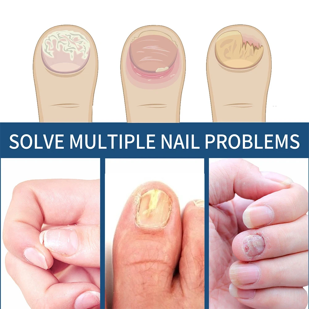 32/96PCS Nail Fungus Repair Patch Discoloration Nail Damaged Thicken Improve Embedded Growth Nail Herbal Addition Body Care Tool
