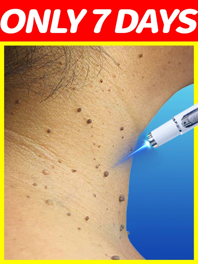 2025 العلامة التجارية الجديدة لإصلاح الثآليل الجذر uickly ترقية الجيل خالية من القلق