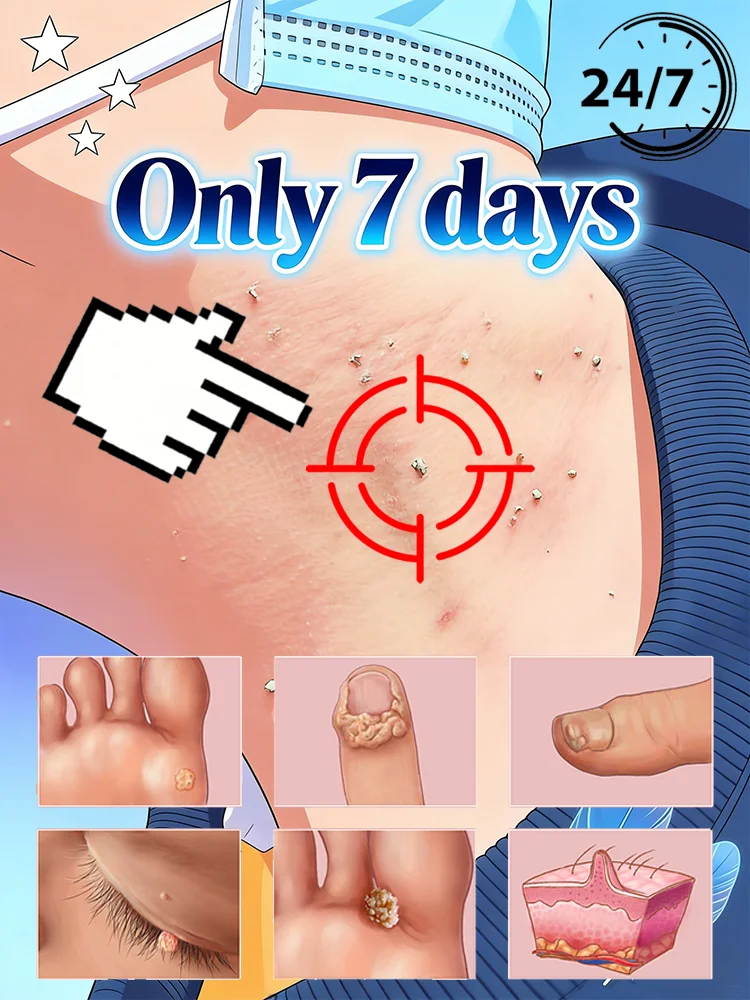 

Hotsale for warts,free shipping,Make your life less troublesome for warts Body tools,unisex