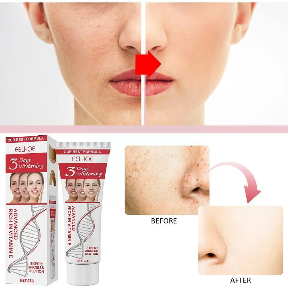 Eelhoe 3 일 코직산 미백 보습 크림, 얼굴 주근깨 다크 크림, 스팟 케어, 브라이트닝 스킨 크림 제거