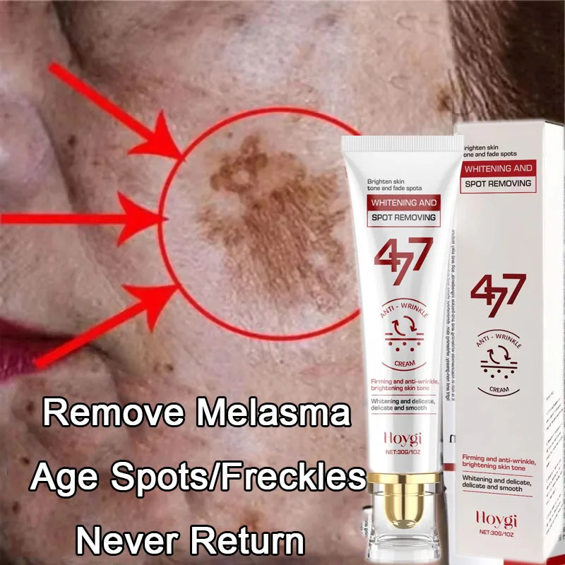 

Effective Whitening Freckles Face Cream Remove Melasma Dark Spots Fade Pigmentation Acne Scars Moisturizing Brighten Beauty Care