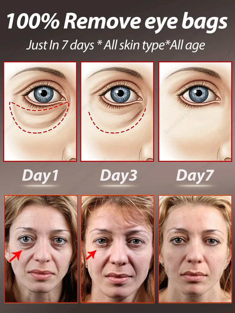Eye Bags Disappear product for 98% of girls，Prevent，Repair