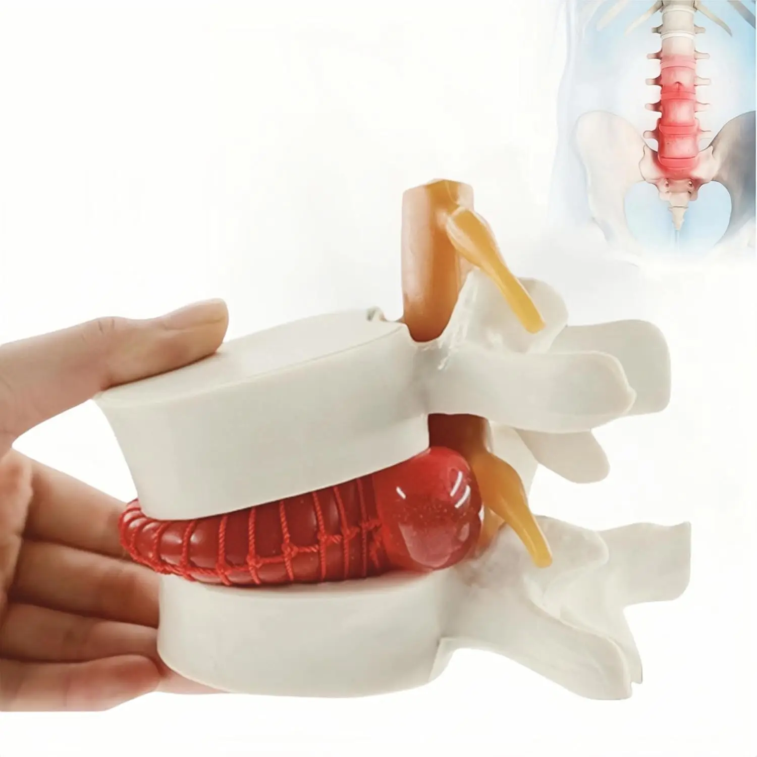 Herniated Disc Spine Model, 1.5X Life Size Lumbar Spine Anatomy Model for Teaching, Chiropractic Demonstration, Medical Learning