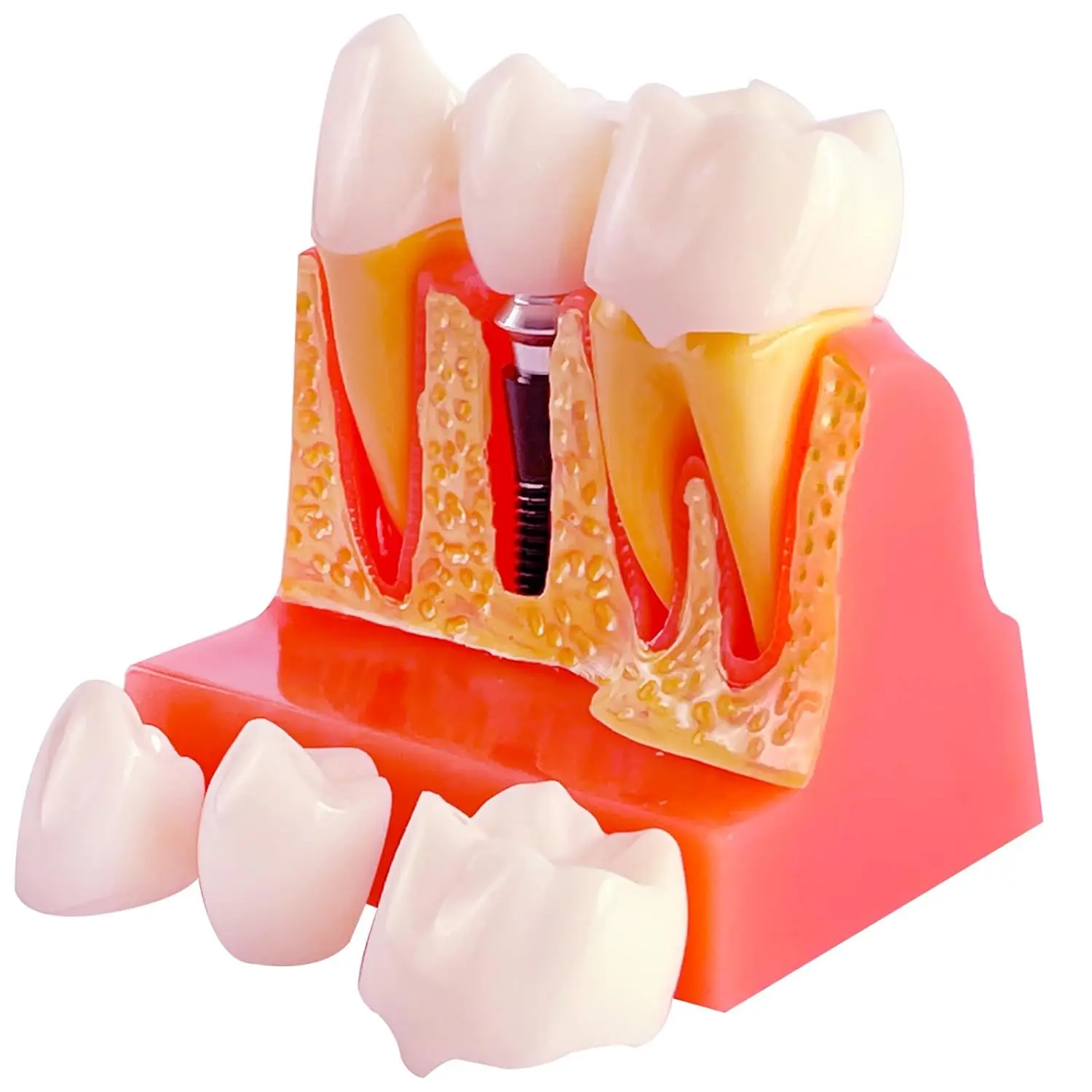 Dental Implant Model with Removable Crown Bridge 4 Times Enlarged Demonstrative Teeth Model Dental Teaching Student Training