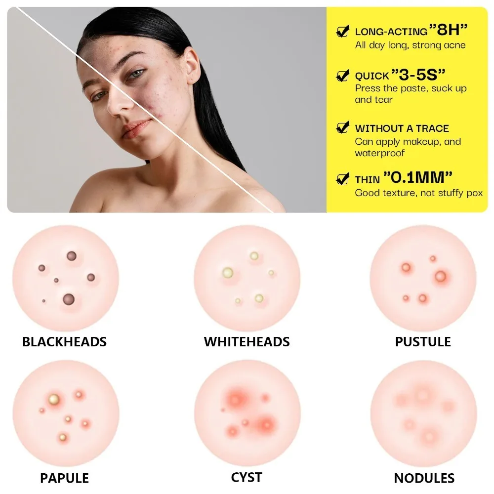 إزالة حب الشباب الغروانية المائية الكبيرة بقع بثرة الوجه بالكامل للأنف والذقن والجبهة والخد وحماية البشرة وتنظيف الوجه