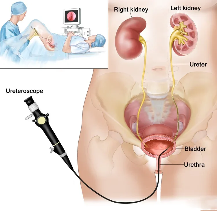 digital electronic single-use ureterorenoscope for uroscopy device diagnosis surgical instruments ureteroscope flexible