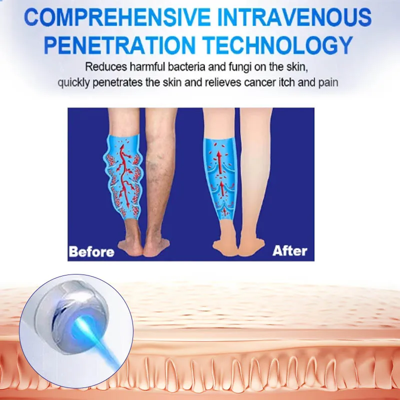 3Pcs Varicose Veins Laser Therapy Pen Relieve Legs Pain Varicose Vein Socks Improve Blood Circulation Leg Care For Men And Women