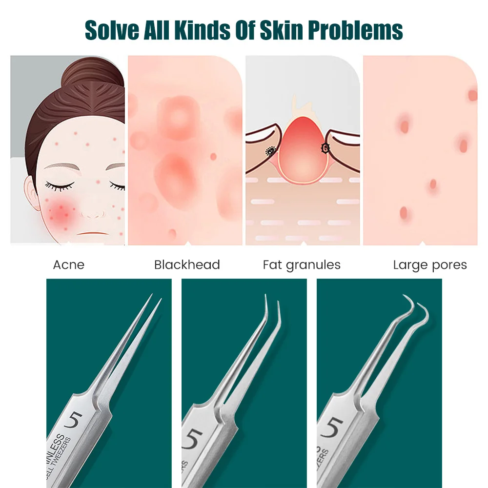 ドイツの極細No. 5 セルニキビにきびクリップピンセットビューティーサロン特別なスクレーピング & クロージングアーティファクトにきび針ツール