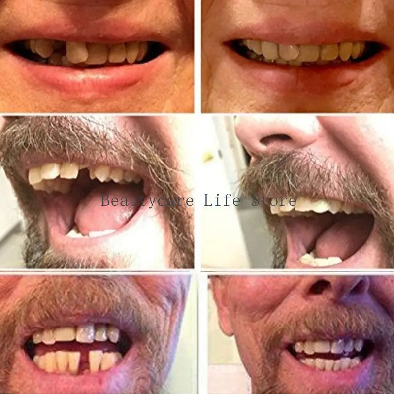 652C 3pcs Dental Teeth Veneers Thin Whiten Resin Molar Anterior Temporary Upper Lower Shade Dental Care Missing Broken Tooth