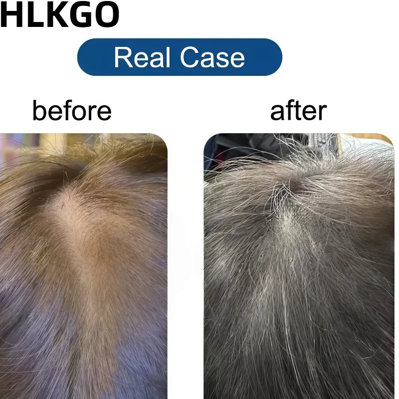 

Медицинский низкоуровневый лазерный терапевтический шлем 650 нм, LLLT Cap для лечения адометической алопеции и роста волос